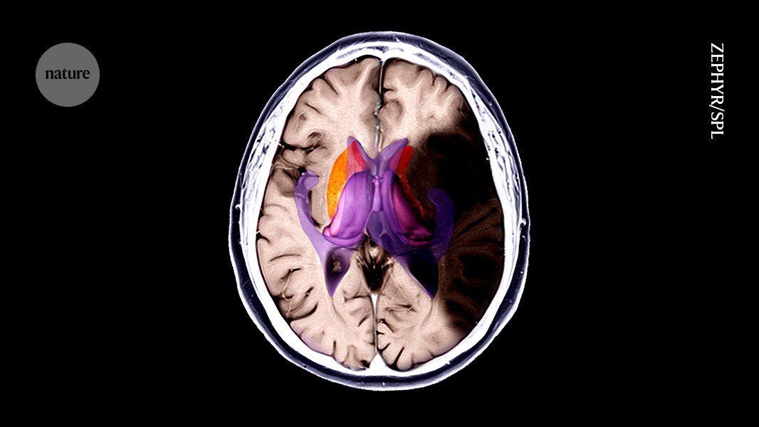 Freezing brain damage in its tracks: cooling drugs limit stroke